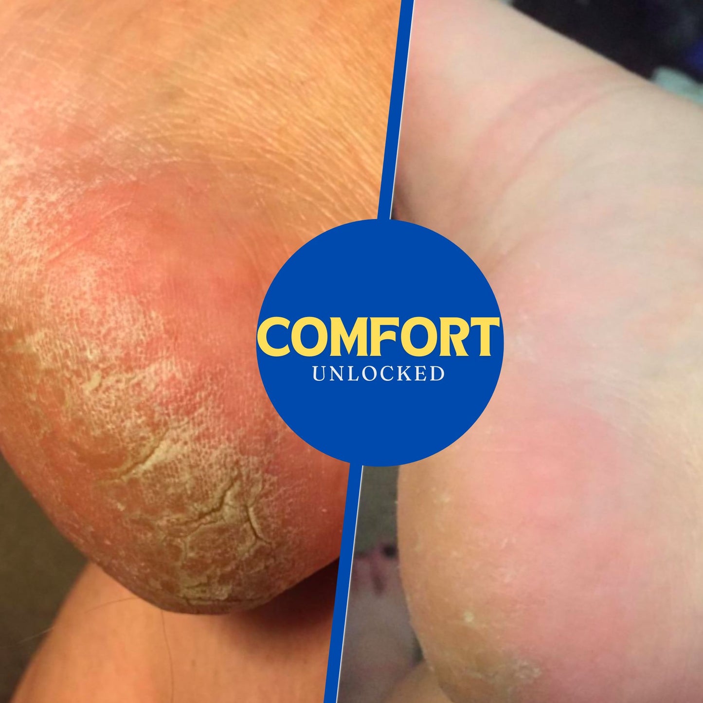 VEROPEEL - Electric Rechargeable Foot Callus Remover
